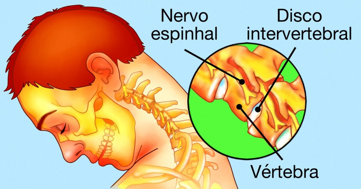 causas de dor no pescoço